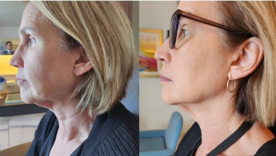 Transformation After